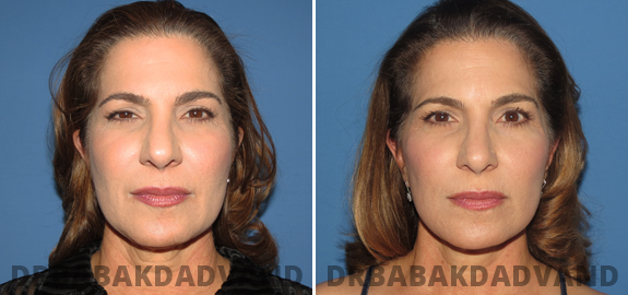 Facelift: Before and After Photos